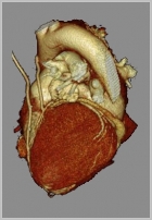 Cardio CT felvétel 3D rekonstrukciója.