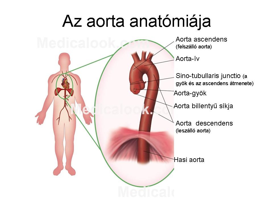 hasi aorta magas vérnyomás esetén