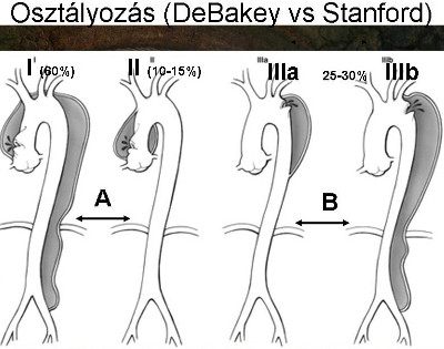 Az aorta dissectiók DeBakey (I-III) és Stanford (A-B) szerinti osztályozása.