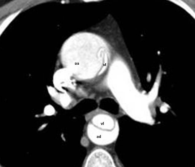 Akut "A" típusú aorta disszekció CT képe.