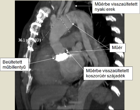 "A" típusú aorta dissectio miatt végzett Bentall műtét és teljes ívcsere controll CT képe.