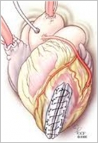 A szívinfarktus szövődményeként létrejött bal kamrai aneurysma linearis resectiójának bemutatása.